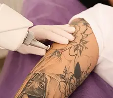Laser Tattoo Removal Los Angeles
